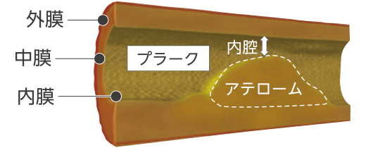 図：アテローム性動脈硬化