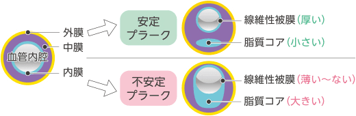 図：安定プラークと不安定プラーク